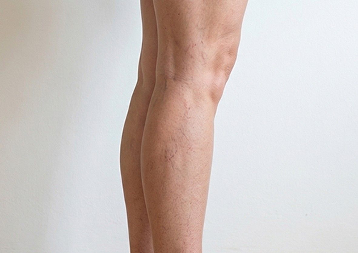 vasculegsft b1